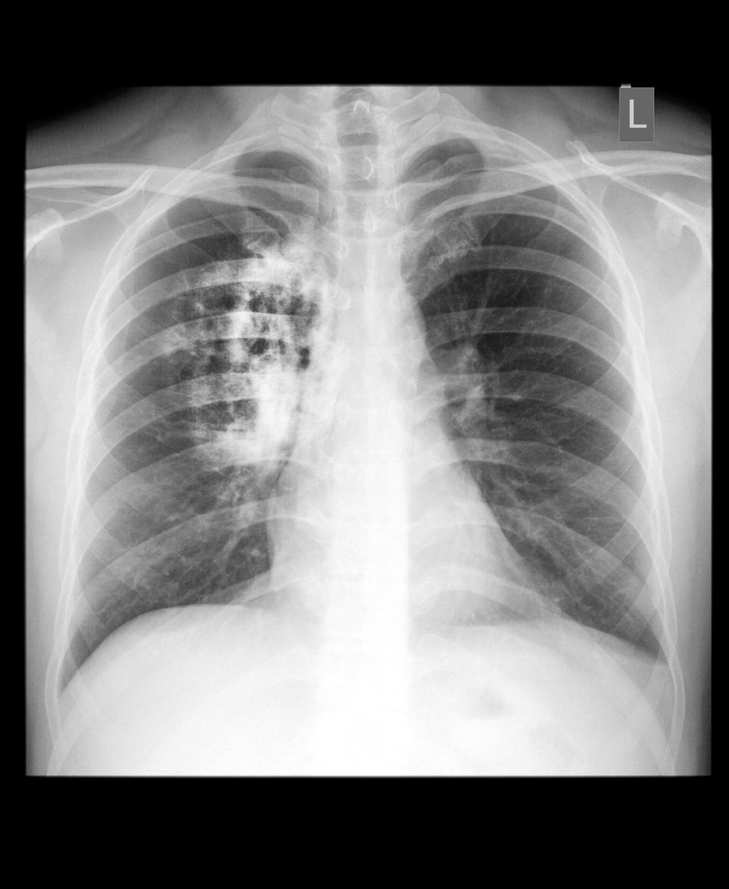 Cancer de pulmon